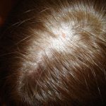 Как долго восстанавливаются волосы после выпадения при стрессе