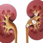 камни в почках