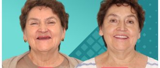 Prosthetics on implants