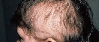 tricholomania in a child